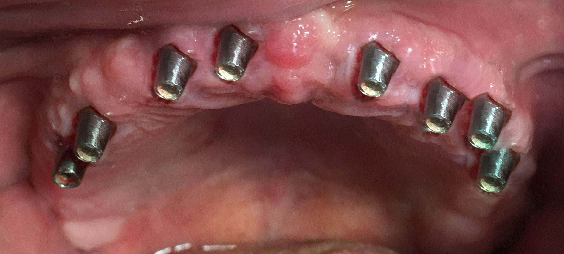 İmplant Simante Sistem Öncesi